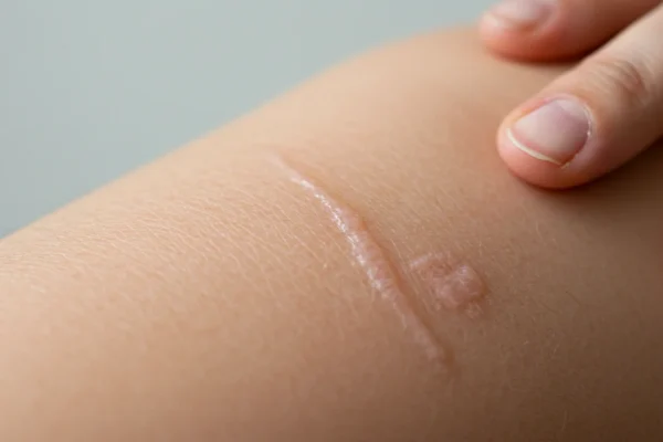 Waxing Scars: 2026 Skin Safety Risks & Fixes